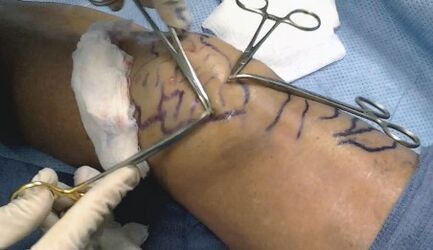 Krampfadern Operation