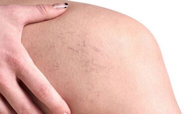 Wie Krampfadern bei Frauen manifestieren