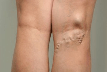 Diagnose von Krampfadern bei schwangeren Frauen.