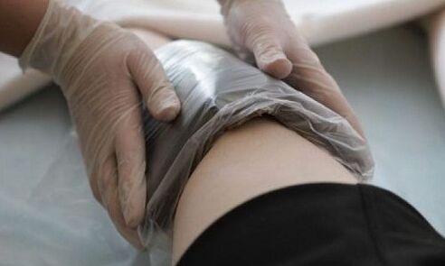 Behandlung von Krampfadern mit Kompressen