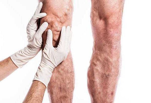 Palpation von Krampfadern in den Beinen.
